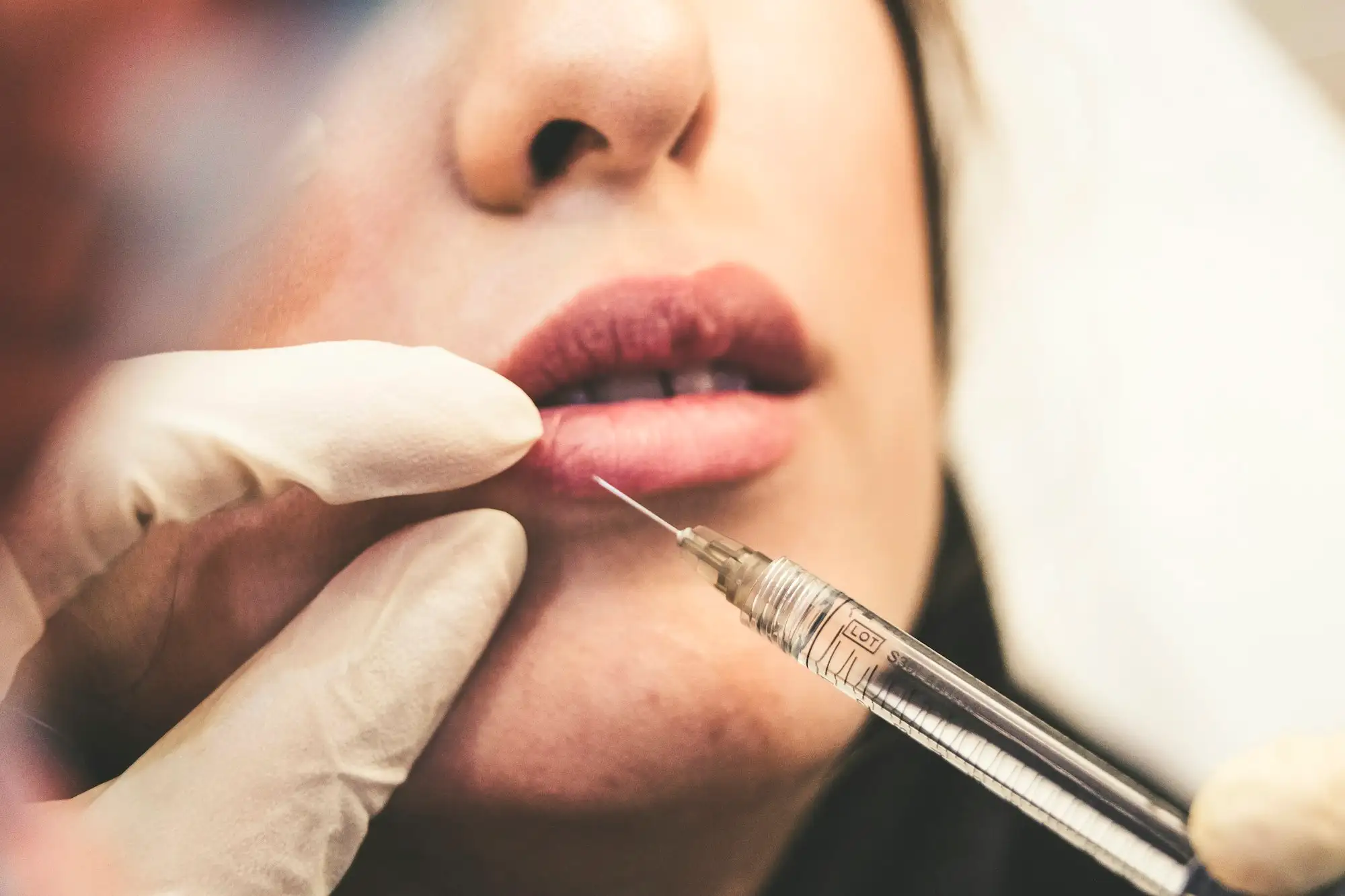 Dermal filler · Sofhyal® · Giofill®